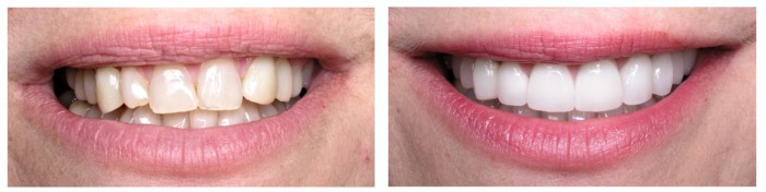Full upper smile enhancement with all ceramic crowns