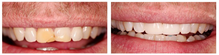 Discolored teeth restored with single visit direct composite bonding
