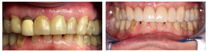 Upper smile enhancement with gum lift and all ceramic E-Max Crowns