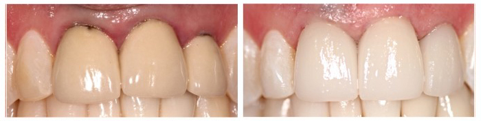 Discolored porcelain to metal crowns restored with all ceramic crowns