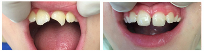 Trauma to front teeth restored with direct composite bonding